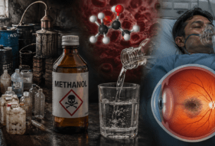 Deadly Brew: How Methanol in Illicit Liquor Triggers Blindness and Fatalities.